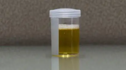 全球首例!女子能用膀胱自动酿酒,无限续杯…