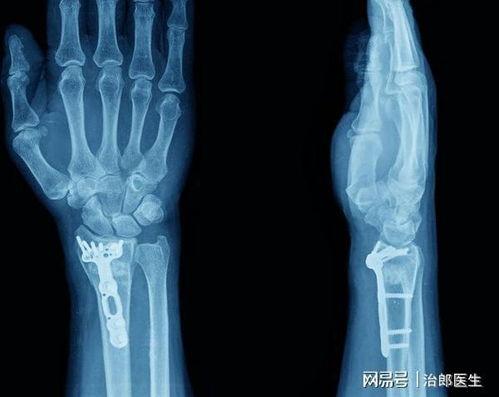 做CT吃饭了有影响吗?全面解析CT检查前的饮食注意事项